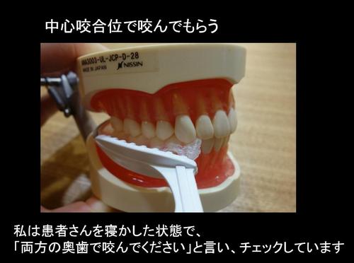 印象・咬合採得が同時にできる【咬合印象法】の手順 咬合印象用